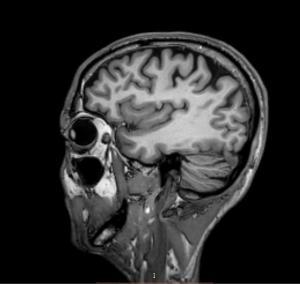 MRI scan 1 - 17 mei 2017