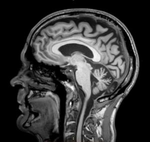MRI scan 2 - 17 mei 2017