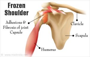 Frozen shoulder